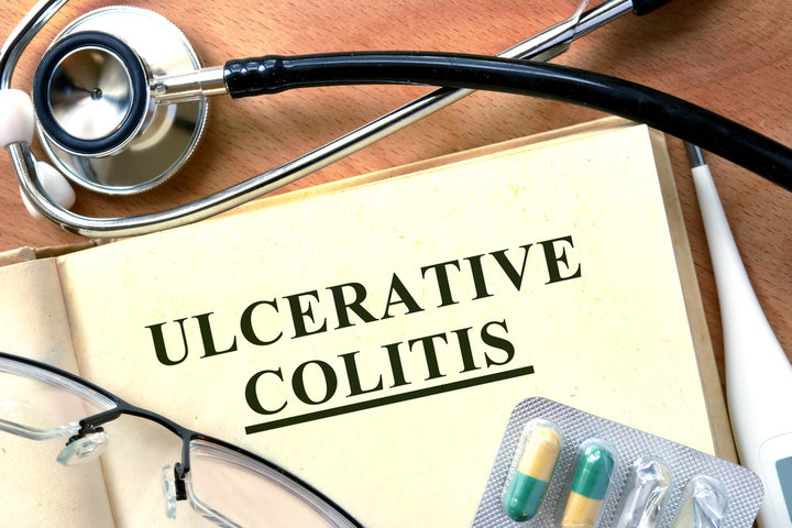 ulcerative colitis